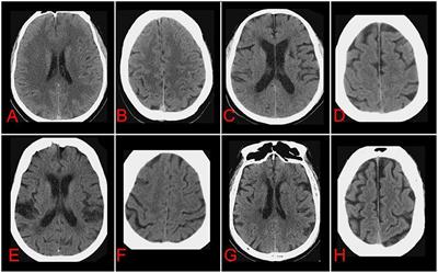 Associations between computed tomography markers of cerebral small vessel disease and hemorrhagic transformation after intravenous thrombolysis in acute ischemic stroke patients